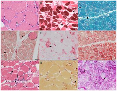 Chloroquine and Hydroxychloroquine Myopathy: Clinical Spectrum and Treatment Outcomes